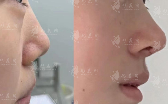 想找深圳文豐醫(yī)生隆鼻?預(yù)約渠道+面診攻略全解析 想找深圳文豐醫(yī)生隆鼻?預(yù)約渠道+面診攻略全解析