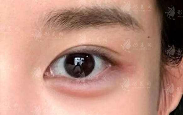 鄭州王楊醫(yī)生臥蠶修復(fù)多少錢?2026價(jià)格表及眼袋費(fèi)用一覽 鄭州王楊醫(yī)生臥蠶修復(fù)多少錢?2026價(jià)格表及眼袋費(fèi)用一覽