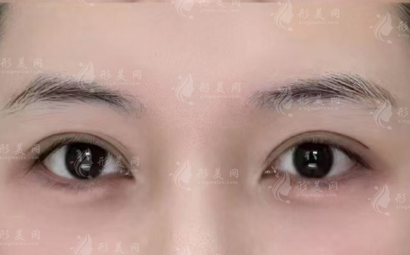 北京雙眼皮修復(fù)哪個醫(yī)生好?于建華/師麗麗/魏志香憑實(shí)力出圈