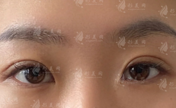 董瑞芳眼修復(fù)技術(shù)好嗎?2026價(jià)格+口碑全揭秘 董瑞芳眼修復(fù)技術(shù)好嗎?2026價(jià)格+口碑全揭秘