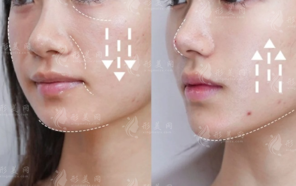 鄭州郭玉瑞面部提升怎么樣?抗衰效果與技術特點全解析 鄭州郭玉瑞面部提升怎么樣?抗衰效果與技術特點全解析