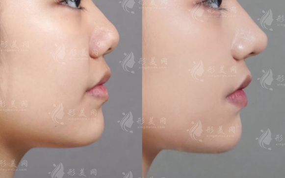 潘峰鼻整形醫(yī)生靠譜嗎?資質(zhì)技術(shù)價格適合人群全解析