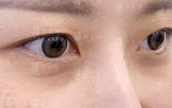 眼袋淚溝黑眼圈怎么區(qū)分?辨別方法與改善方案全攻略 眼袋淚溝黑眼圈怎么區(qū)分?辨別方法與改善方案全攻略