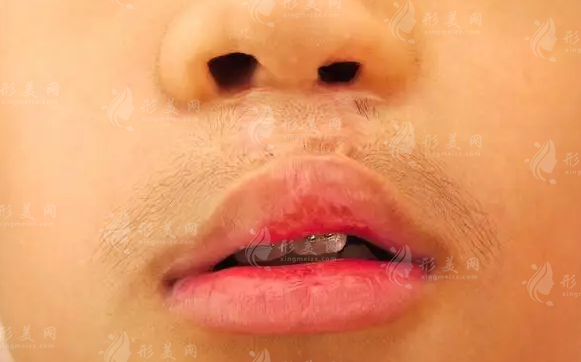 陳國鼎醫(yī)生唇裂手術(shù)費用貴?技術(shù)優(yōu)勢全揭秘 陳國鼎醫(yī)生唇裂手術(shù)費用貴?技術(shù)優(yōu)勢全揭秘