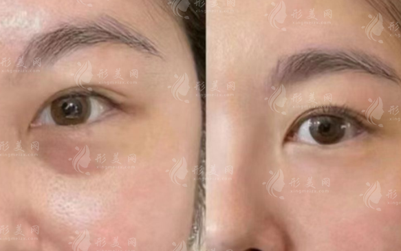 黃石無(wú)痕去眼袋效果好嗎？?jī)r(jià)格多少？適合哪些人？