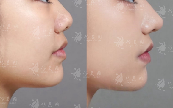 上海柳棒醫(yī)生隆鼻靠譜嗎?自然風(fēng)格+技術(shù)優(yōu)勢(shì)深度解析 上海柳棒醫(yī)生隆鼻靠譜嗎?自然風(fēng)格+技術(shù)優(yōu)勢(shì)深度解析