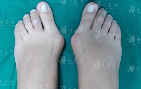 烏魯木齊大腳骨手術(shù)哪家好?青松星范伊麗莎白華美排名揭秘