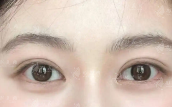 武漢做雙眼皮哪家醫(yī)院好?前十正規(guī)機(jī)構(gòu)技術(shù)特點(diǎn)盤點(diǎn)