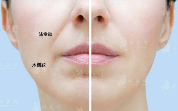 法令紋明顯該填玻尿酸還是做提拉?一文看懂怎么選
