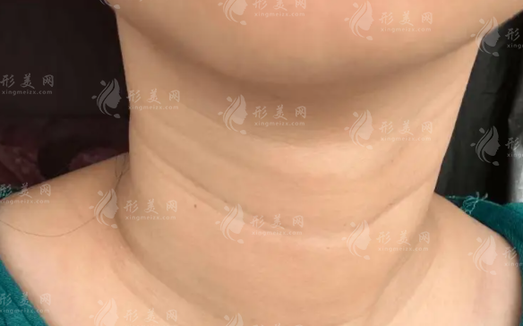頸紋怎么消除?日常護(hù)理+醫(yī)美方法全攻略 頸紋怎么消除?日常護(hù)理+醫(yī)美方法全攻略