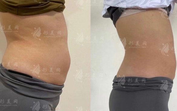 玲瓏體雕能塑形嗎?效果分析+適合人群一文說(shuō)清