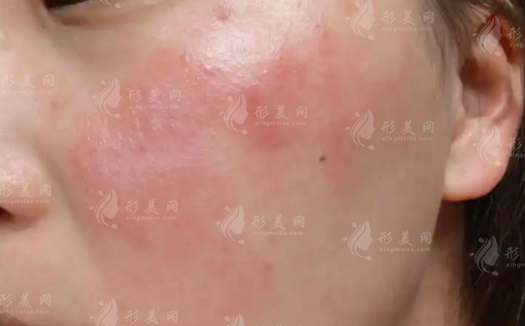 敏感肌屏障受損怎么修復(fù)?急救攻略+護(hù)膚指南