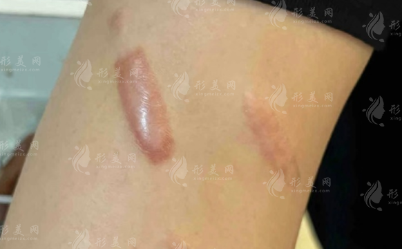 沈陽華美疤痕修復(fù)中心靠譜嗎?技術(shù)+價格+口碑全解析