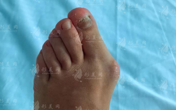 溫建民拇外翻手術(shù)靠譜嗎?微創(chuàng)技術(shù)+費用+適合人群詳解