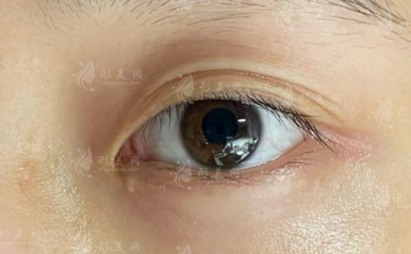 楊胤恒修復(fù)饅化口碑如何?術(shù)后靈動自然不僵硬!