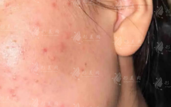 油痘肌救星!超光子聯(lián)合黃金微針，皮膚"水泥封層"新方案實測