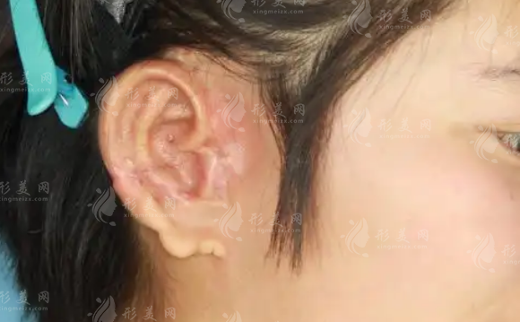 鄭州耳再造哪家好? 當(dāng)?shù)厝肆ν凄嵵菡蚊廊葆t(yī)院+張正文