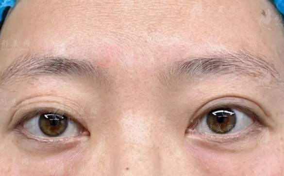 眼袋手術(shù)后會(huì)復(fù)發(fā)嗎?術(shù)后護(hù)理+預(yù)防攻略一次說清