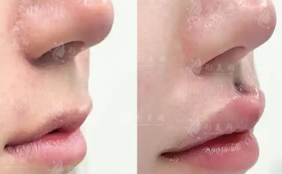 杭州馮嘯醫(yī)生技術(shù)怎么樣?臥蠶、人中、嘴巴三大項目解析
