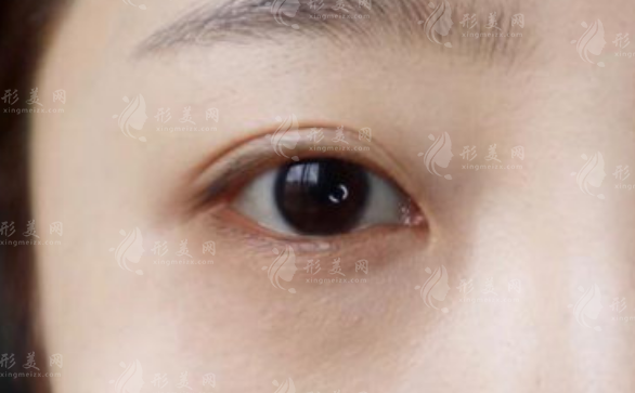 上海眼修復(fù)醫(yī)生排名前三?楊洪波高難度修復(fù)技術(shù)揭秘 上海眼修復(fù)醫(yī)生排名前三?楊洪波高難度修復(fù)技術(shù)揭秘