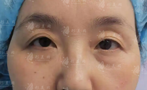 北京田永成切眼袋多少錢?2026年價格表+避坑指南