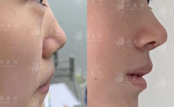 深圳鴻瑞醫(yī)療張輝坐診!赫本鼻+鼻修復(fù)價(jià)格全公開(kāi)