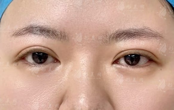 北京雙眼皮修復(fù)醫(yī)生推薦：晶美魏志香技術(shù)口碑全解析