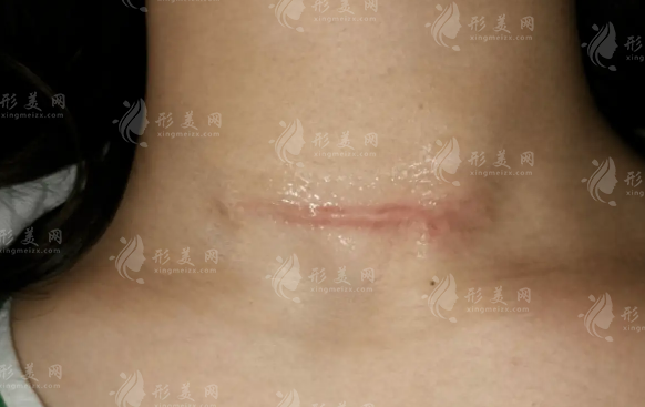沈陽華美疤痕醫(yī)院靠譜嗎?祛疤技術硬核價格透明!