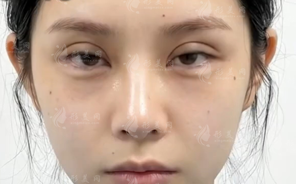 無錫雙眼皮修復(fù)找歐陽黎平靠譜嗎?技術(shù)價(jià)格全解析 無錫雙眼皮修復(fù)找歐陽黎平靠譜嗎?技術(shù)價(jià)格全解析