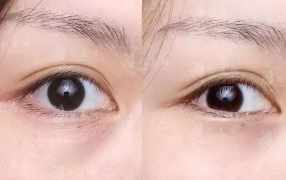 鄭州雙眼皮醫(yī)生排名前十!張芳申麗等十位技術(shù)大比拼 鄭州雙眼皮醫(yī)生排名前十!張芳申麗等十位技術(shù)大比拼
