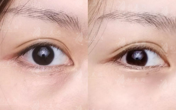 北京眼修復(fù)哪家好?晶美魏志香院長雙眼皮修復(fù)價格表及攻略全解析 北京眼修復(fù)哪家好?晶美魏志香院長雙眼皮修復(fù)價格表及攻略全解析