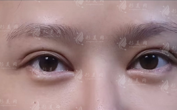 杭州雙眼皮修復哪家好?藝星和維多利亞技術(shù)大比拼! 杭州雙眼皮修復哪家好?藝星和維多利亞技術(shù)大比拼!