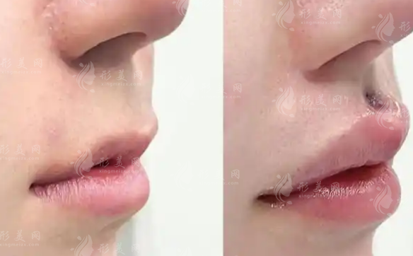 人中縮短手術(shù)適合誰?做完會留疤嗎?2026面部比例科普 人中縮短手術(shù)適合誰?做完會留疤嗎?2026面部比例科普