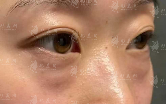 深圳祛眼袋醫(yī)院哪家好?這五家正規(guī)機(jī)構(gòu)口碑實(shí)力雙在線 深圳祛眼袋醫(yī)院哪家好?這五家正規(guī)機(jī)構(gòu)口碑實(shí)力雙在線