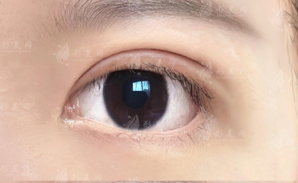 深圳秦王馳雙眼皮技術(shù)好嗎?媽生感風(fēng)格+價格全解析 深圳秦王馳雙眼皮技術(shù)好嗎?媽生感風(fēng)格+價格全解析