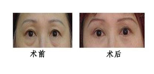 提眉術(shù)效果怎么樣呢