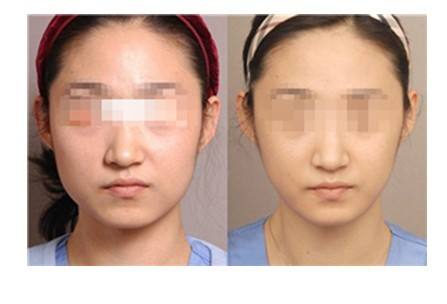 瘦臉針只對咬肌肥大才有效果嗎