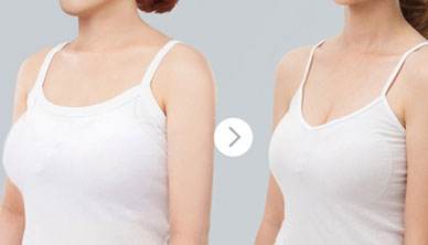 巨乳縮小的費(fèi)用是多少