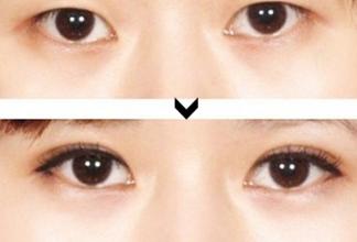 韓式雙眼皮技術(shù)優(yōu)勢