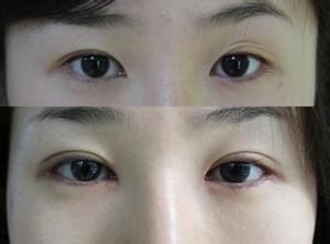 提眉價(jià)格影響因素