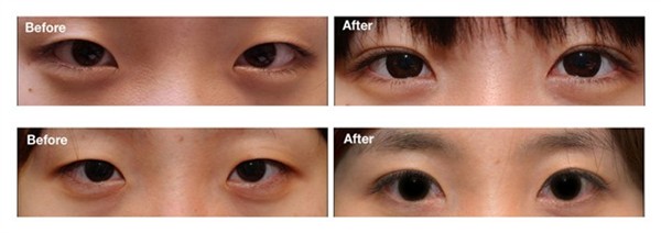 上眼臉手術(shù)有哪些危害