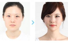 面部輪廓整形的效果如何?