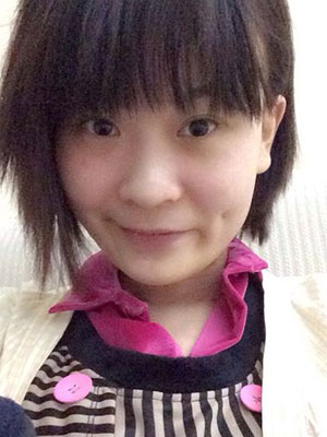 酒窩成形術對比照 打造甜美系女生