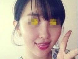 下頜骨整形對比照 輕松打造小v臉