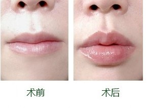 玻尿酸豐唇效果維持多久