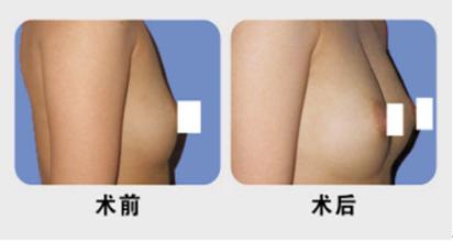 乳頭整形注意事項(xiàng)