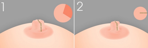 乳頭縮小對(duì)比照