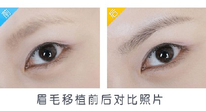 哪些人適合做眉毛移植