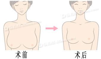 巨乳縮小手術(shù)注意事項