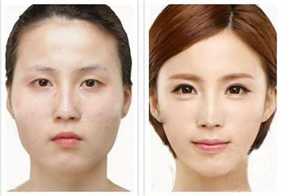 上瞼松弛整形手術有哪些方法